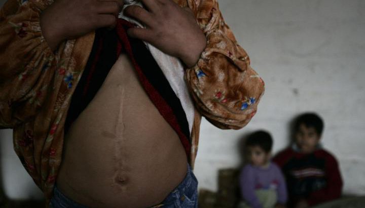 Een 11 jaar oud Irakees meisje laat een litteken zien, het gevolg van een mortier aanval in 2005. Bron: UNHCR, K. Brooks